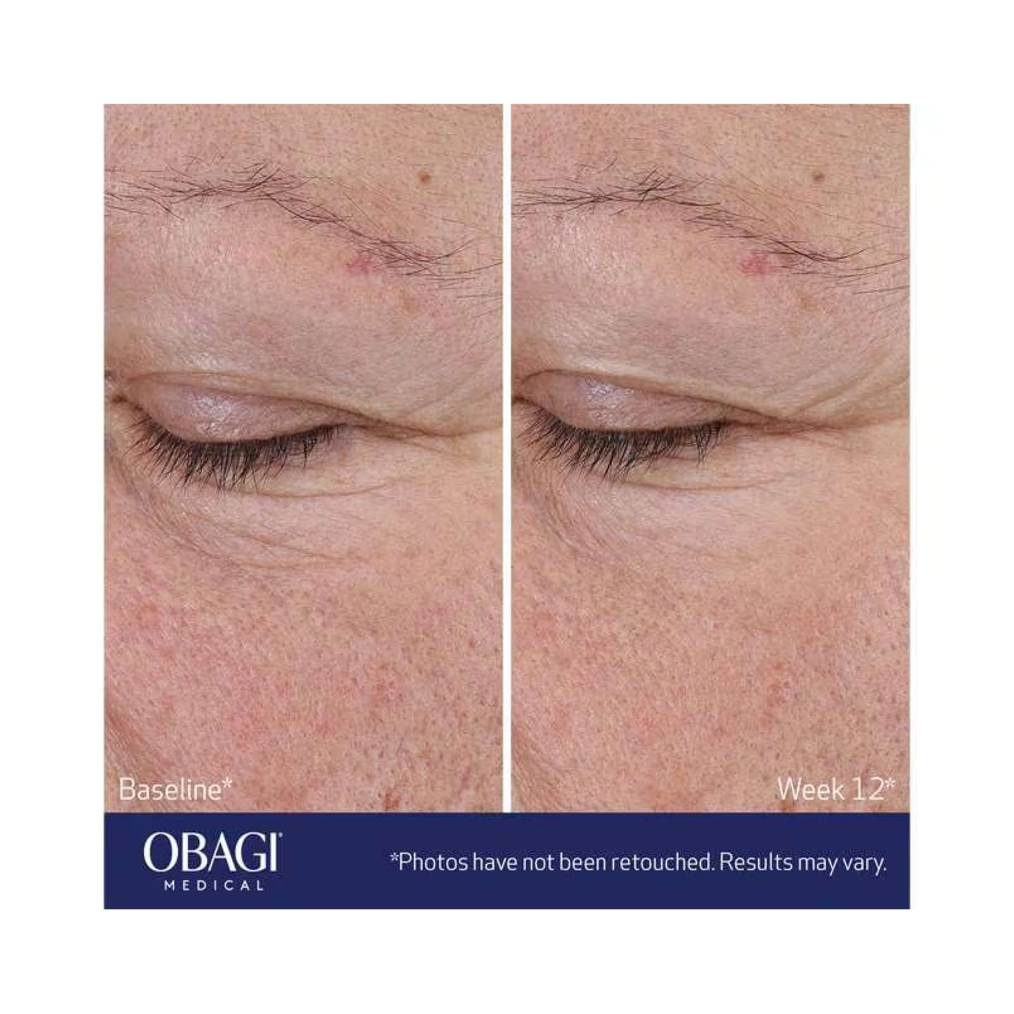 Obagi ELASTIderm® Advanced Filler Concentrate