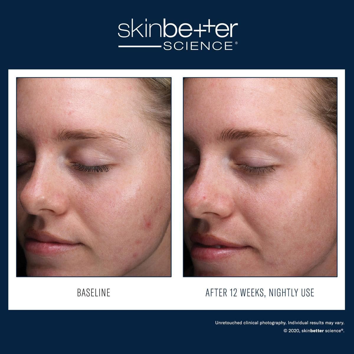 Skinbetter Science - AlphaRet Clearing Serum