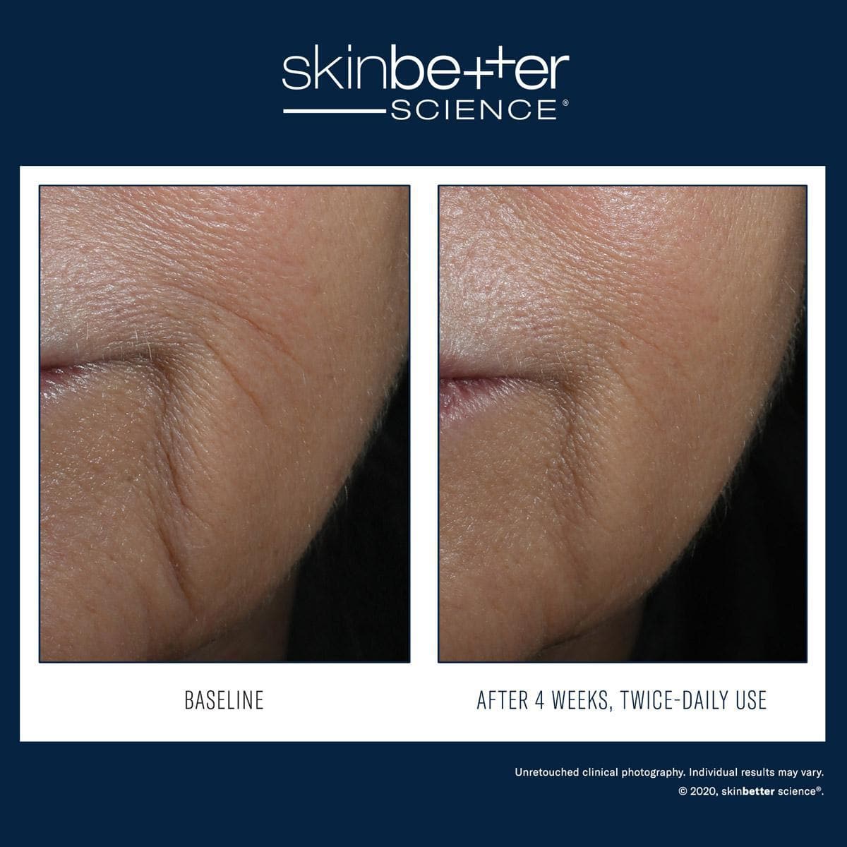 Skinbetter Science - Interfuse Intensive Treatment Lines