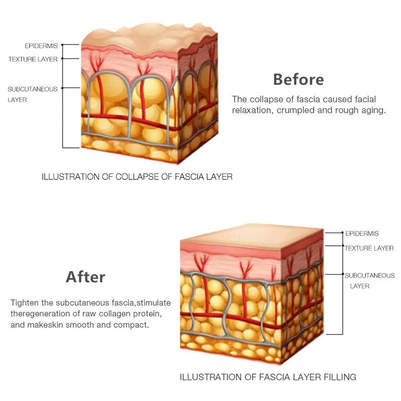 Mini HIFU Machine for Face Ultrasound Machine Skin Care Products RF Fadiofrecuencia Facial Face Lifting Anti Wrinkles Tightening