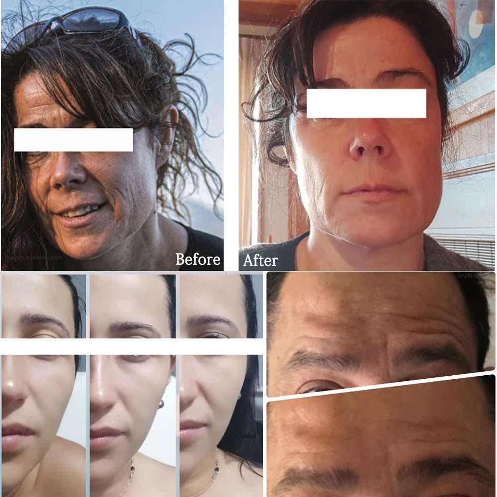 Mini HIFU Machine for Face Ultrasound Machine Skin Care Products RF Fadiofrecuencia Facial Face Lifting Anti Wrinkles Tightening