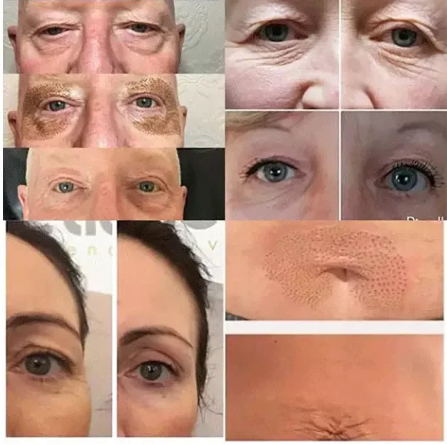 Professional Eyelid Lifting Plasma Pen Beauty Skin Care Device Fibroblast Plasma Pen