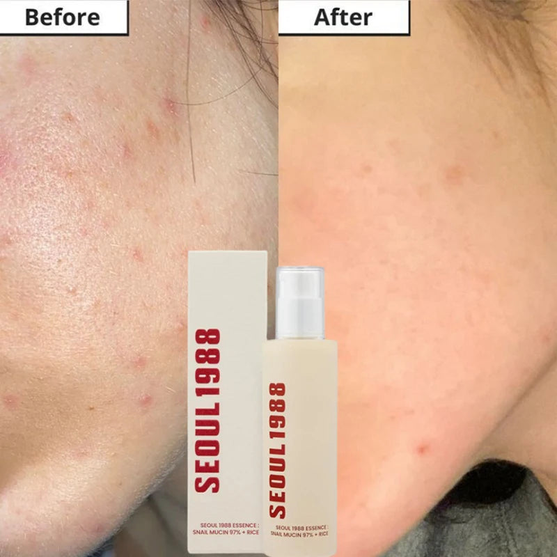 Seoul 1988 Korean Skin Care Set Snail Mucin Eye Contour Care Vitamin C Retinol Dark Circles Removal Seoul 1988 Korean Cosmetics