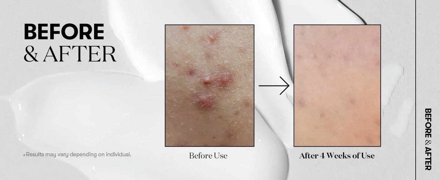 Korean Exosome & Hyaluronic Acid Microneedle Serum - 50ml Skin Booster