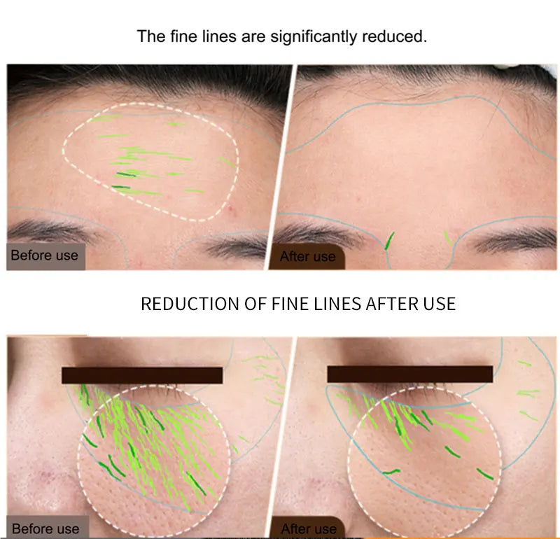 EMS Facial Body Radio Frequency Machine Skin Tightening Face Lifting RF Beauty Device Professional Home RF Skin Care Anti Aging