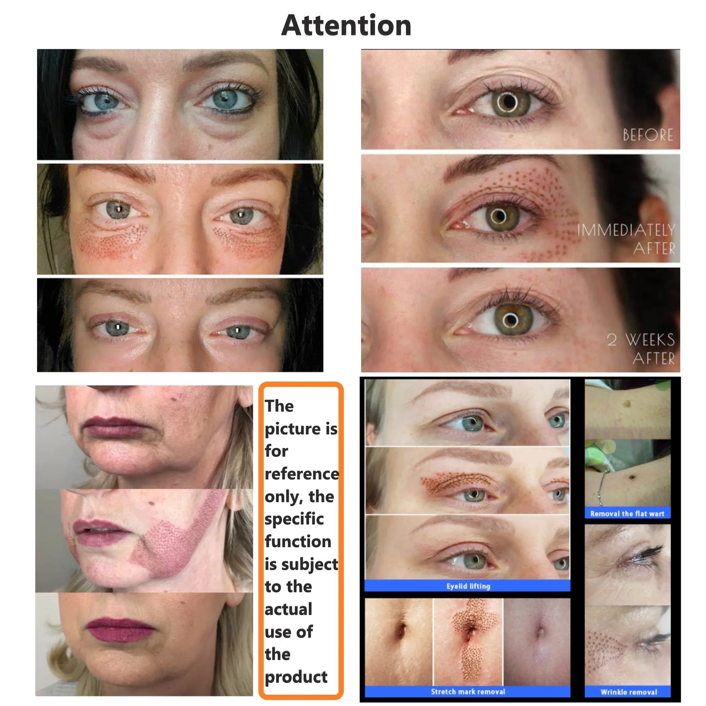 Hicovo Plasma Pen Orignal Fibroblast Wart Skin Tag Anti Wrinkle Remove Quick Charge Auto Acne Treatment Facial Lifting Machine